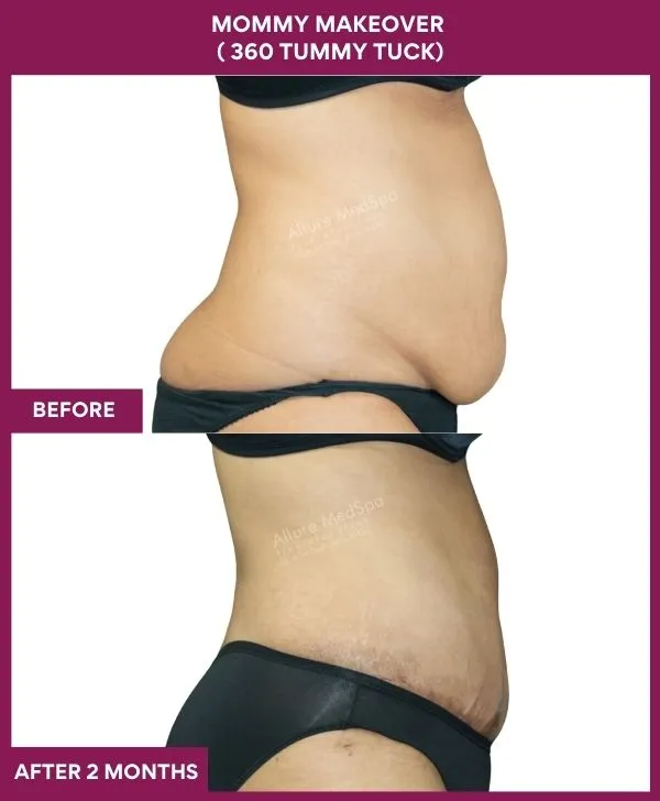 mommy-makeover-360-tummy-tuck-before-after-results-mumbai-india-patient09-side-right
