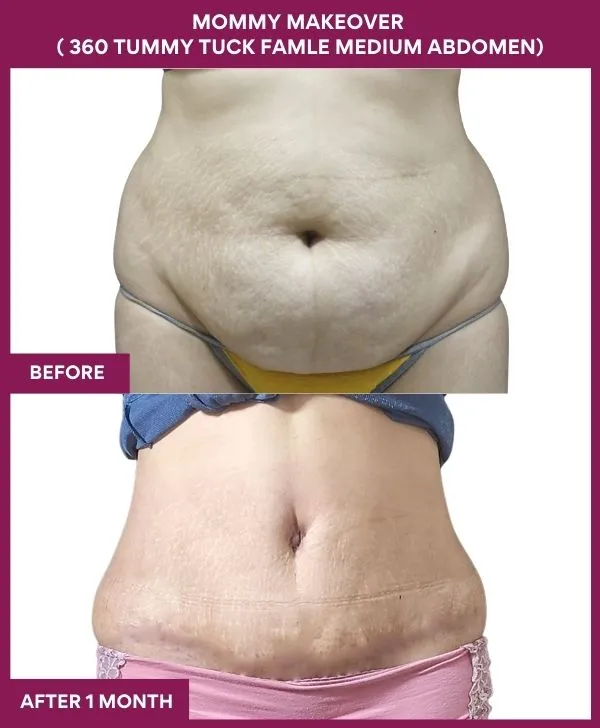 mommy-makeover-360-tummy-tuck-before-after-results-mumbai-india-patient10-front