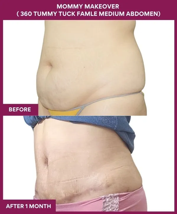 mommy-makeover-360-tummy-tuck-before-after-results-mumbai-india-patient10-side-left