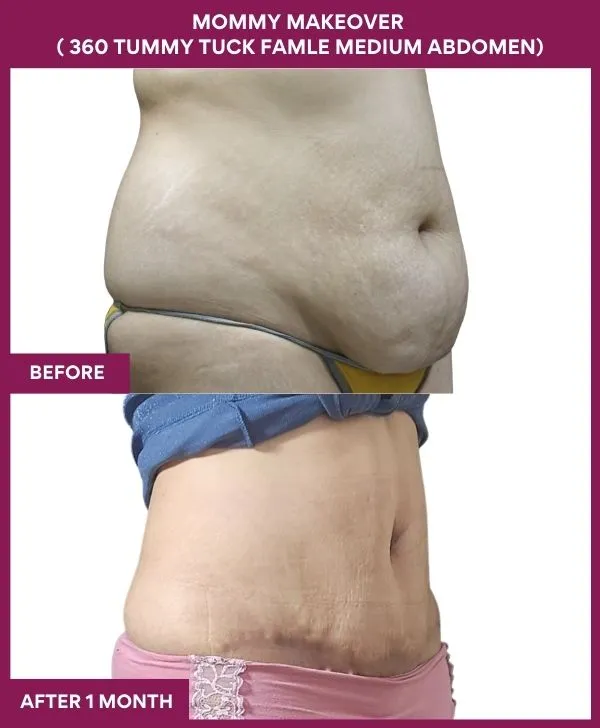 mommy-makeover-360-tummy-tuck-before-after-results-mumbai-india-patient10-side-right