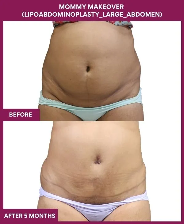 mommy-makeover-360-tummy-tuck-before-after-results-mumbai-india-patient11-front
