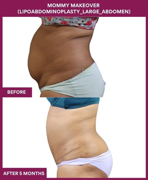 mommy-makeover-360-tummy-tuck-before-after-results-mumbai-india-patient11-side-left