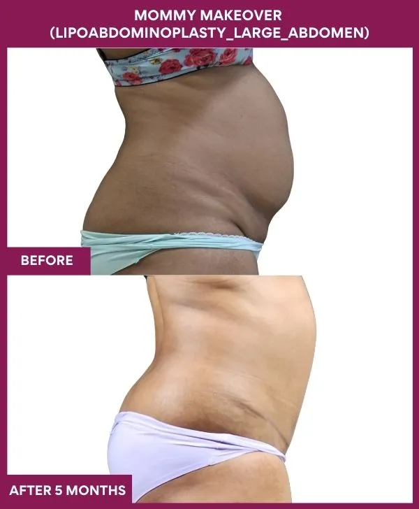 mommy-makeover-360-tummy-tuck-before-after-results-mumbai-india-patient11-side-right
