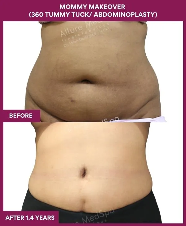 mommy-makeover-360-tummy-tuck-before-after-results-mumbai-india-patient12-front