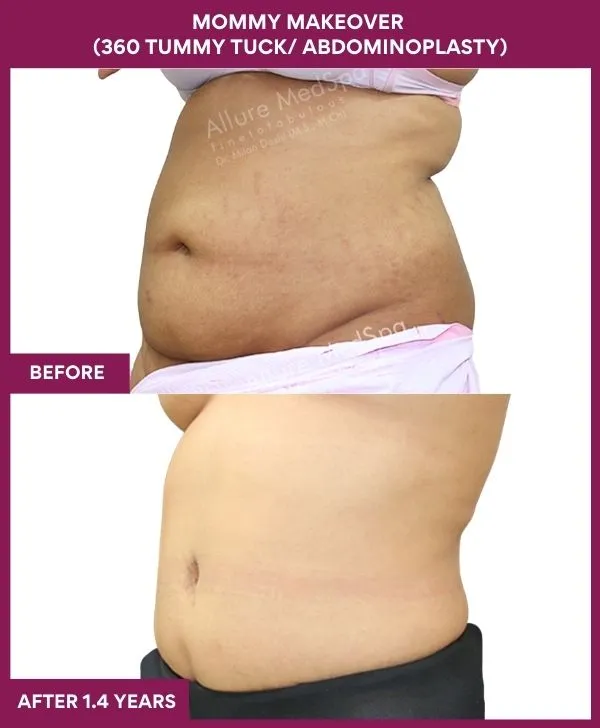 mommy-makeover-360-tummy-tuck-before-after-results-mumbai-india-patient12-side-left