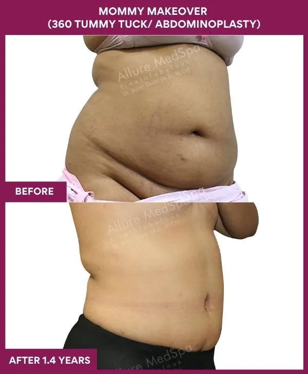 mommy-makeover-360-tummy-tuck-before-after-results-mumbai-india-patient12-side-right