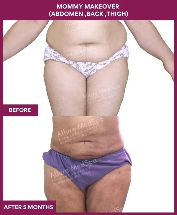 mommy-makeover-abdomen-liposuction-before-after-results-mumbai-india-patient01-front