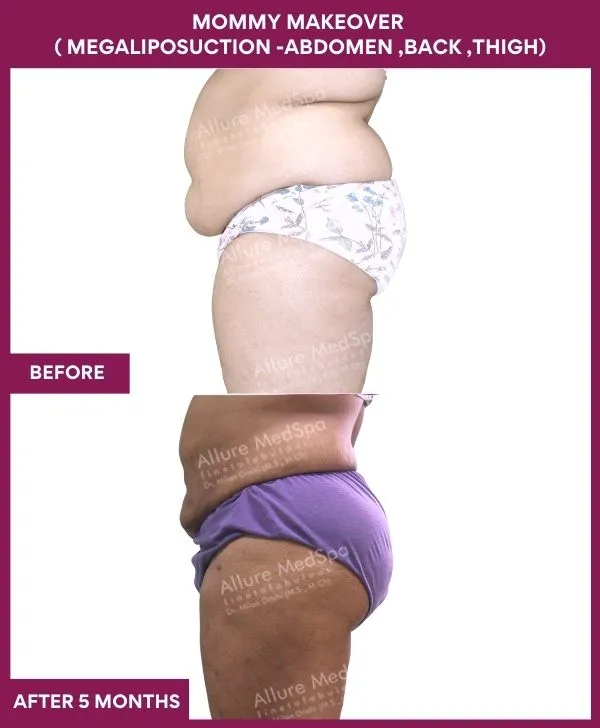 mommy-makeover-abdomen-liposuction-before-after-results-mumbai-india-patient01-side-left