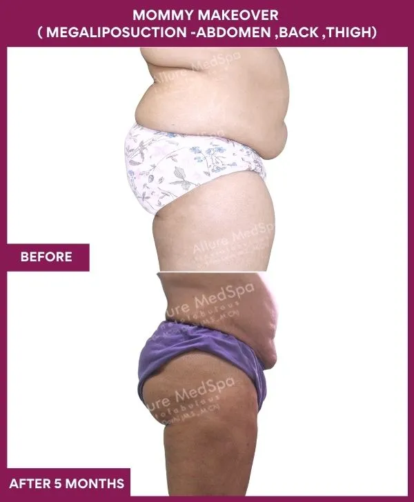 mommy-makeover-abdomen-liposuction-before-after-results-mumbai-india-patient01-side-right