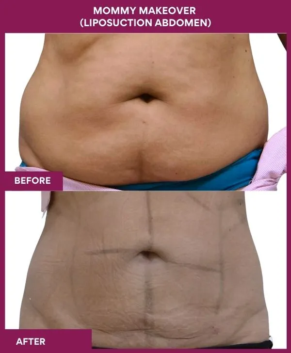 mommy-makeover-abdomen-liposuction-before-after-results-mumbai-india-patient03-front
