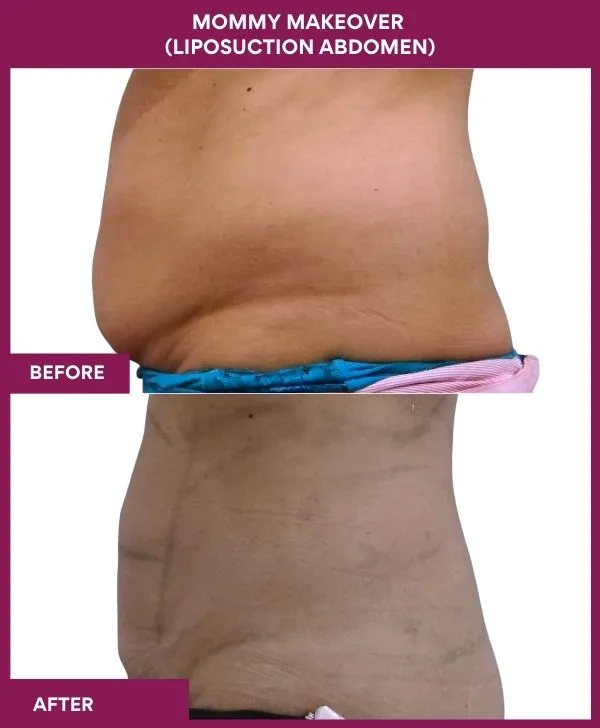 mommy-makeover-abdomen-liposuction-before-after-results-mumbai-india-patient03-side-left