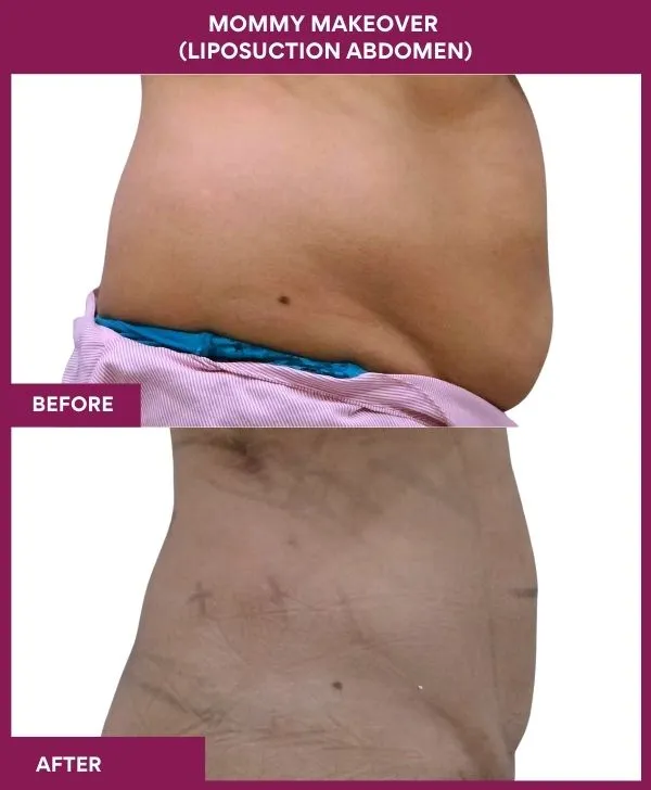 mommy-makeover-abdomen-liposuction-before-after-results-mumbai-india-patient03-side-right