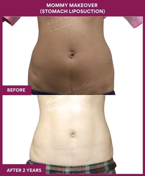 mommy-makeover-abdomen-liposuction-before-after-results-mumbai-india-patient04-front