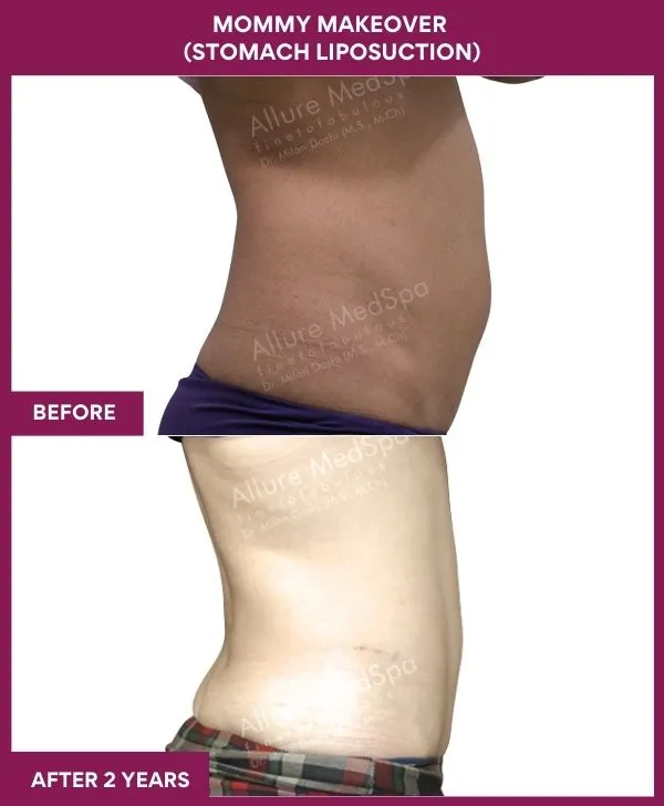 mommy-makeover-abdomen-liposuction-before-after-results-mumbai-india-patient04-sdie-right