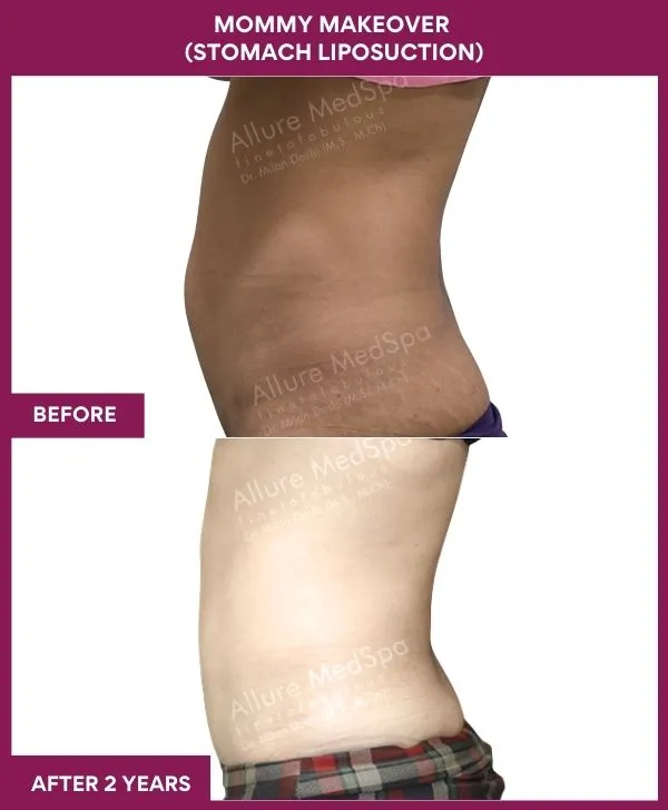 mommy-makeover-abdomen-liposuction-before-after-results-mumbai-india-patient04-side-left