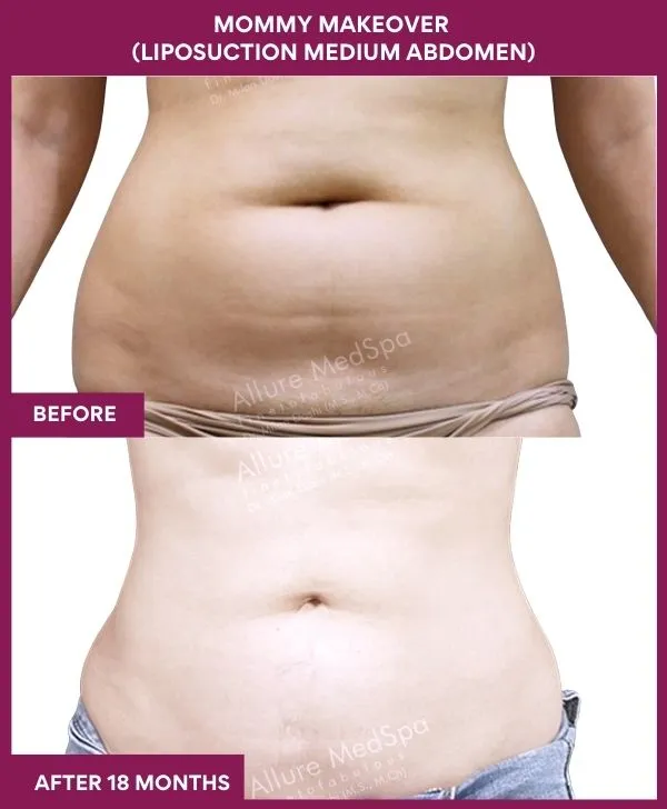 mommy-makeover-abdomen-liposuction-before-after-results-mumbai-india-patient05-front