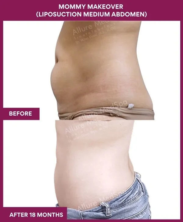 mommy-makeover-abdomen-liposuction-before-after-results-mumbai-india-patient05-side-left