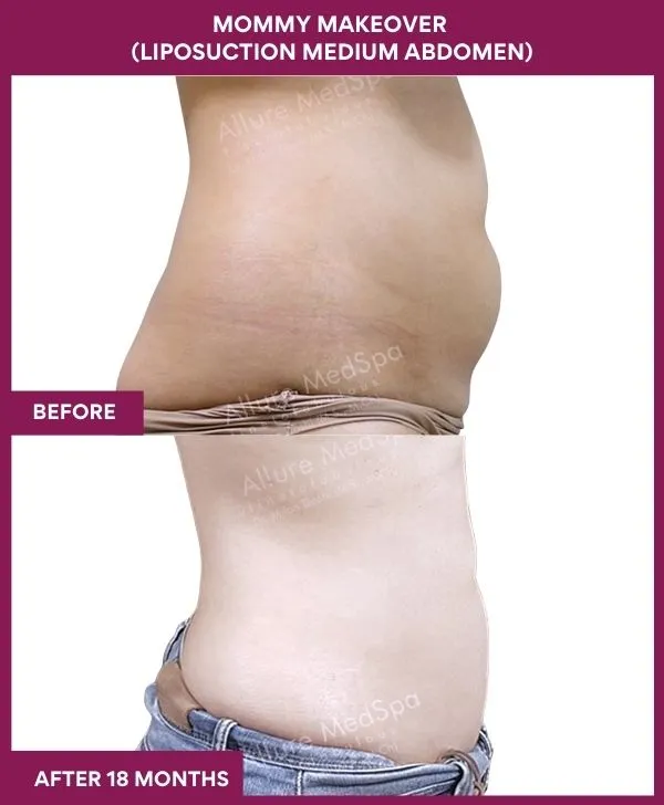 mommy-makeover-abdomen-liposuction-before-after-results-mumbai-india-patient05-side-right