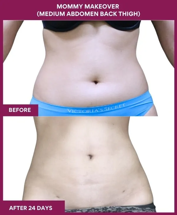 mommy-makeover-abdomen-liposuction-before-after-results-mumbai-india-patient06-front