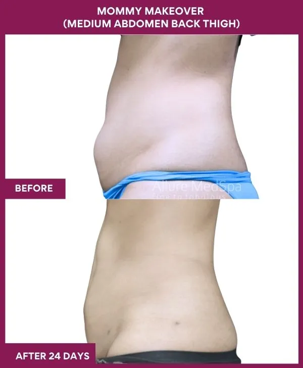 mommy-makeover-abdomen-liposuction-before-after-results-mumbai-india-patient06-side-left