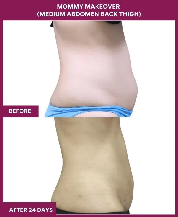 mommy-makeover-abdomen-liposuction-before-after-results-mumbai-india-patient06-side-right