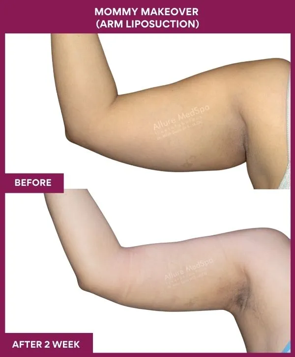 mommy-makeover-arm-liposuction-before-after-results-mumbai-india-patient03-side-left