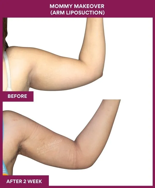 mommy-makeover-arm-liposuction-before-after-results-mumbai-india-patient03-side-right
