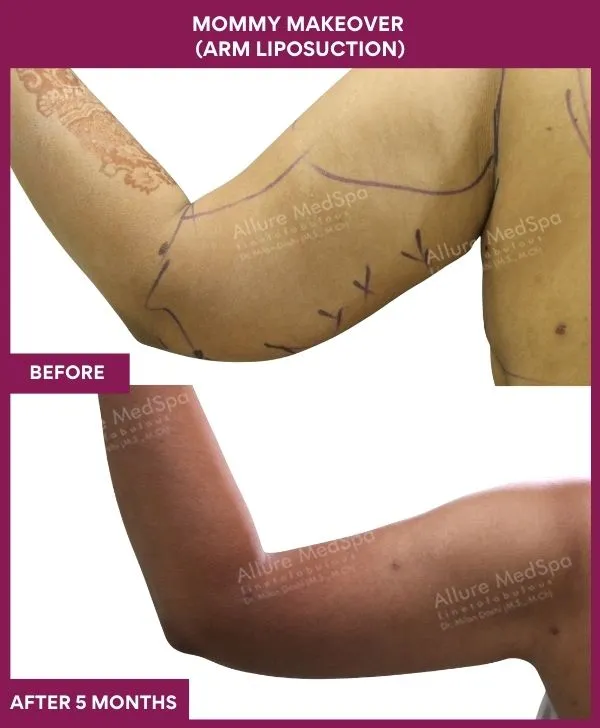 mommy-makeover-arm-liposuction-before-after-results-mumbai-india-patient04-backside-left