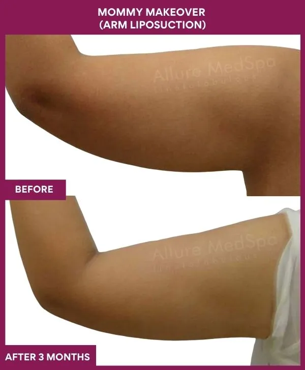 mommy-makeover-arm-liposuction-before-after-results-mumbai-india-patient05-backside-left