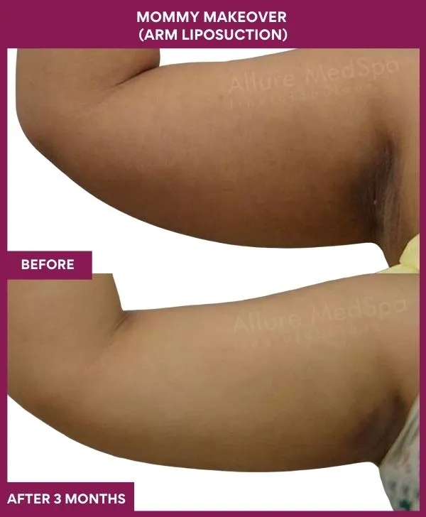 mommy-makeover-arm-liposuction-before-after-results-mumbai-india-patient05-side-left