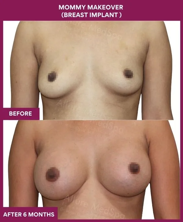 mommy-makeover-breast-implant-with-lift-before-after-results-mumbai-india-patient02-front