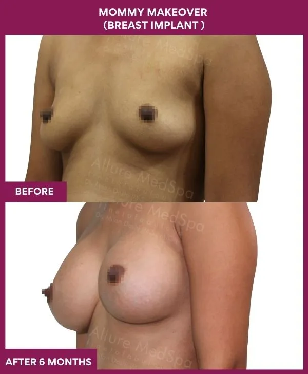 mommy-makeover-breast-implant-with-lift-before-after-results-mumbai-india-patient02-side-lkeft