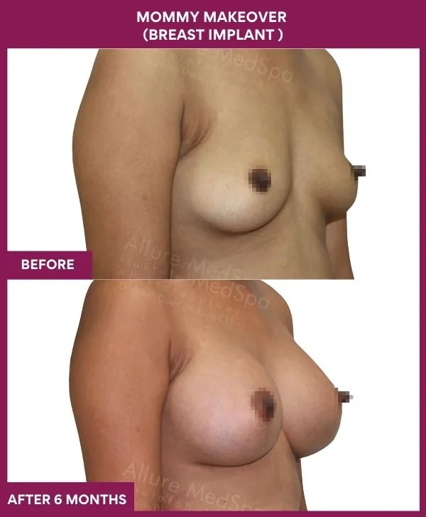 mommy-makeover-breast-implant-with-lift-before-after-results-mumbai-india-patient02-side-right