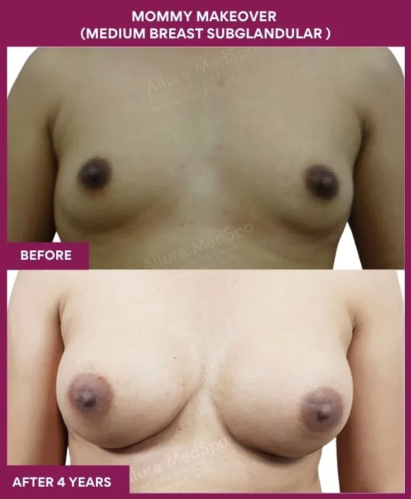 mommy-makeover-breast-implant-with-lift-before-after-results-mumbai-india-patient03-front