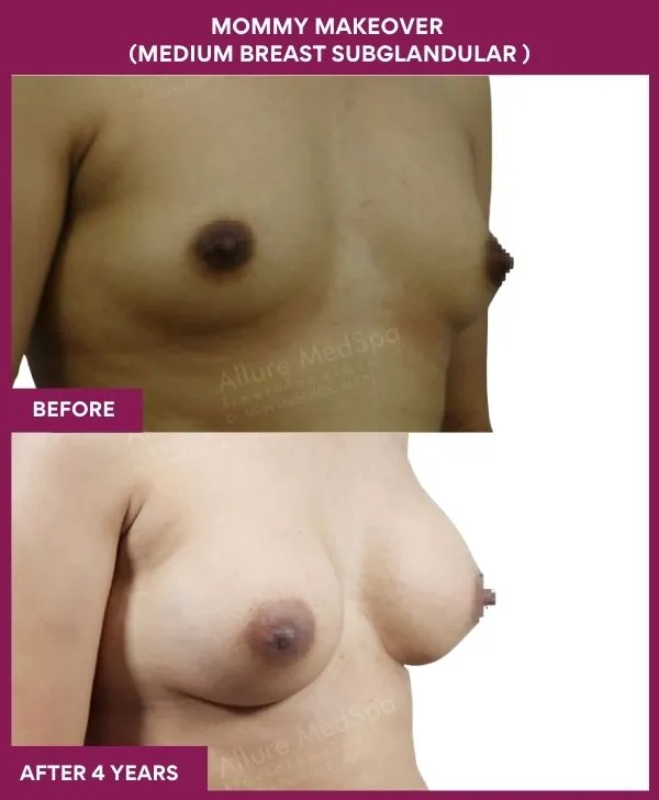 mommy-makeover-breast-implant-with-lift-before-after-results-mumbai-india-patient03-side-right