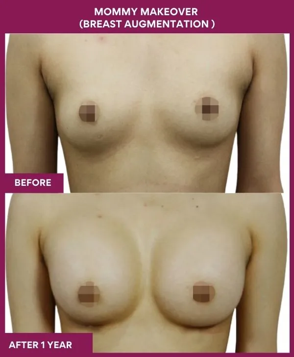 mommy-makeover-breast-implant-with-lift-before-after-results-mumbai-india-patient04-front