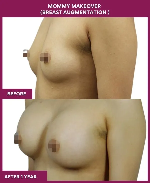 mommy-makeover-breast-implant-with-lift-before-after-results-mumbai-india-patient04-side-left