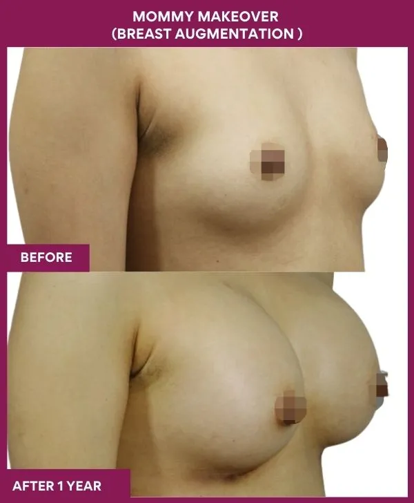 mommy-makeover-breast-implant-with-lift-before-after-results-mumbai-india-patient04-side-right