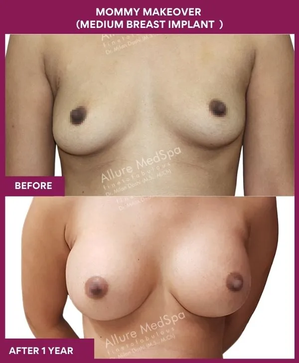 mommy-makeover-breast-implant-with-lift-before-after-results-mumbai-india-patient05-front