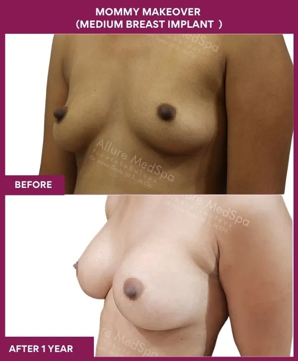 mommy-makeover-breast-implant-with-lift-before-after-results-mumbai-india-patient05-side-left