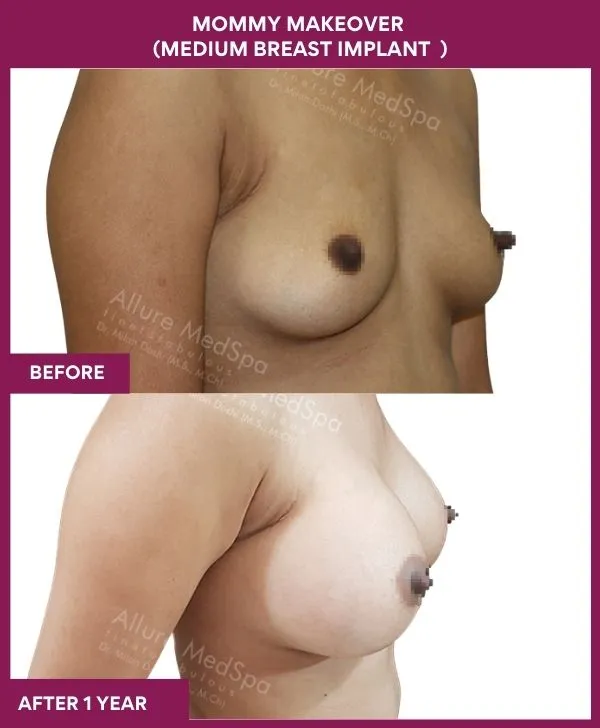 mommy-makeover-breast-implant-with-lift-before-after-results-mumbai-india-patient05-side-right