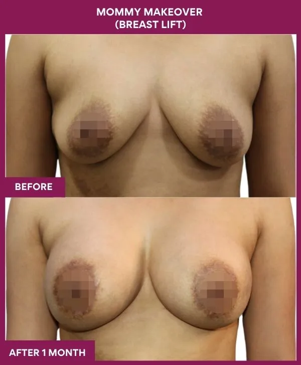 mommy-makeover-breast-lift-surgery-before-after-results-mumbai-india-patient03-front