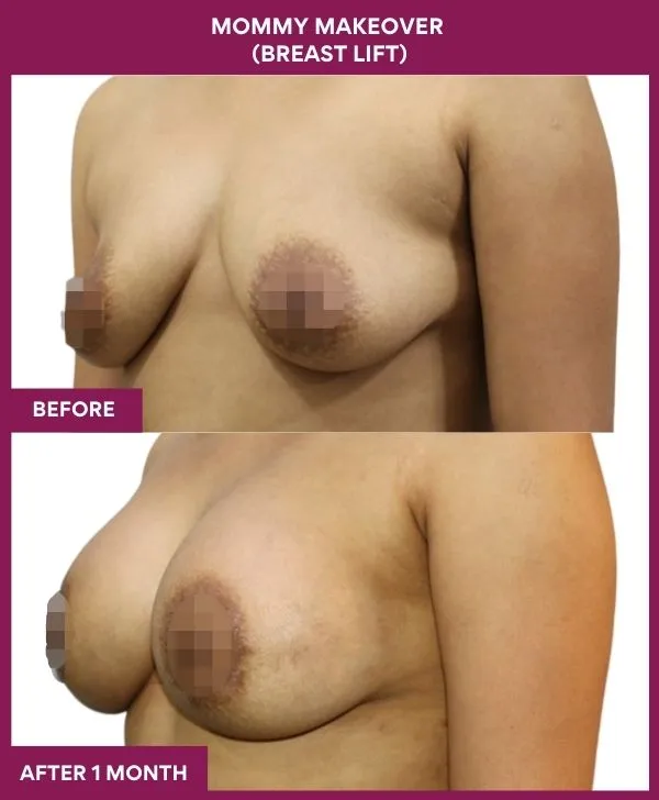 mommy-makeover-breast-lift-surgery-before-after-results-mumbai-india-patient03-sdie-left