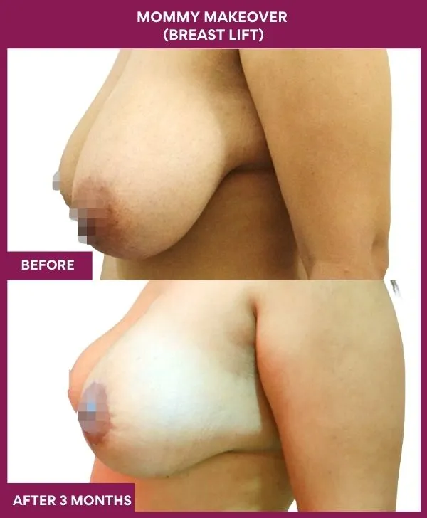 mommy-makeover-breast-lift-surgery-before-after-results-mumbai-india-patient04-side-left