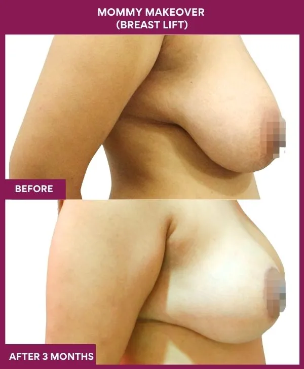 mommy-makeover-breast-lift-surgery-before-after-results-mumbai-india-patient04-side-right