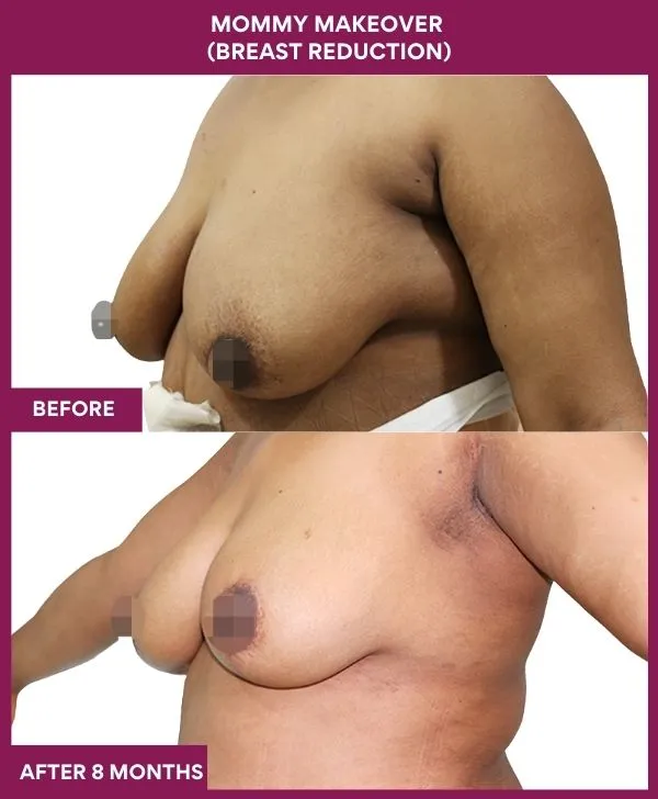mommy-makeover-breast-reduction-surgery-before-after-results-mumbai-india-patient01-side-left