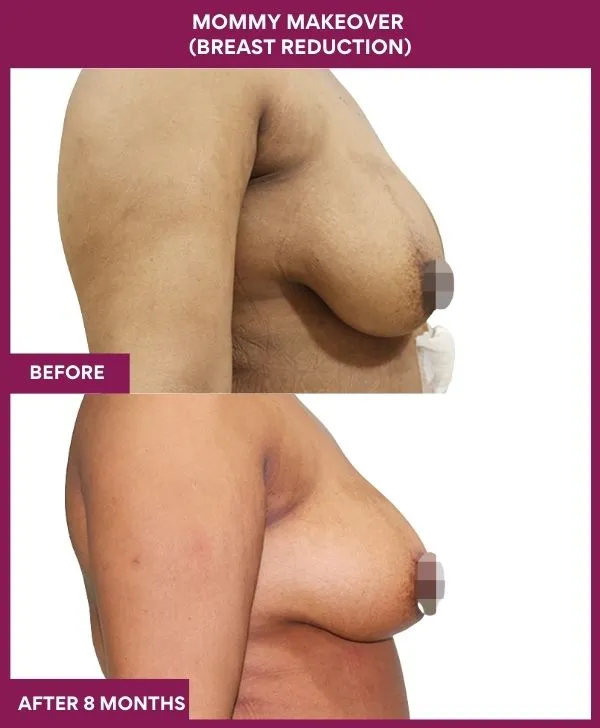 mommy-makeover-breast-reduction-surgery-before-after-results-mumbai-india-patient01-side-right