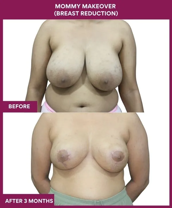 mommy-makeover-breast-reduction-surgery-before-after-results-mumbai-india-patient03-front