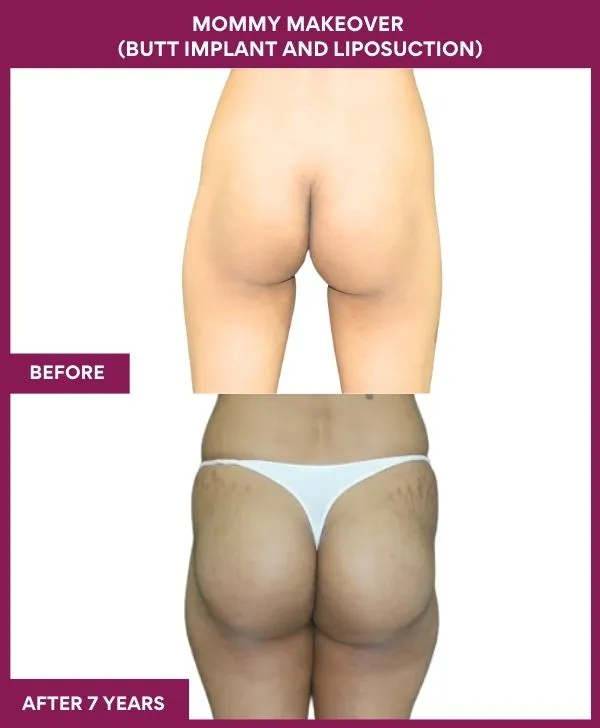 mommy-makeover-buttock-implants-before-after-results-mumbai-india-patient01-back