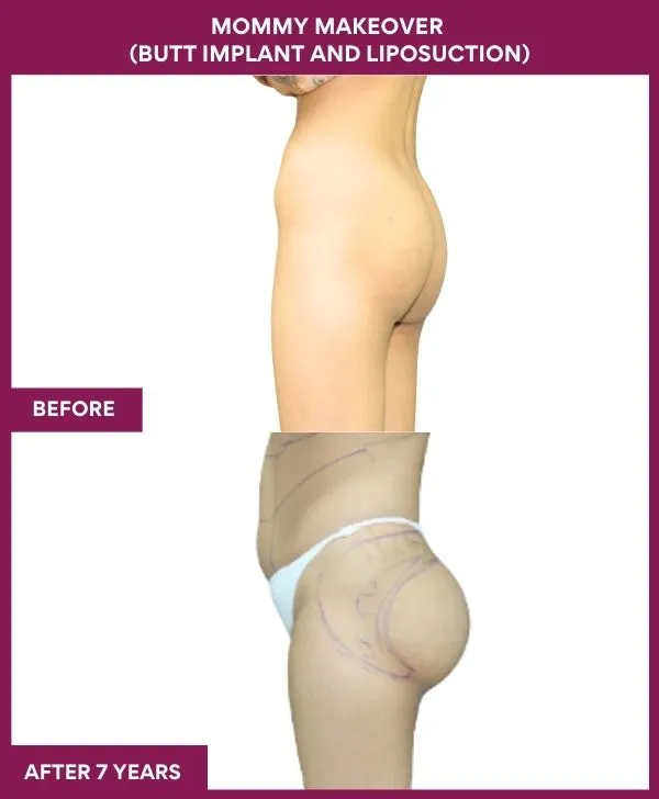 mommy-makeover-buttock-implants-before-after-results-mumbai-india-patient01-side-left
